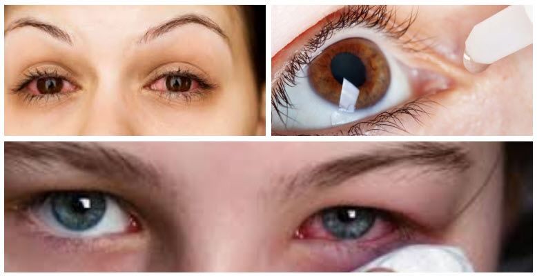 حساسية العين .. الدليل الشامل الأسباب – الاعراض – التشخيص - العلاج